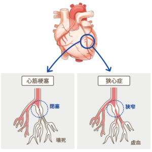 狭心症と心筋梗塞の違い