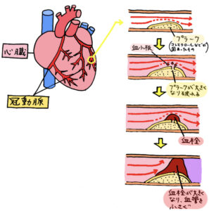 狭心症や心筋梗塞について