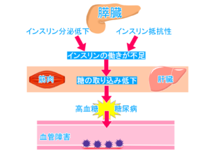 ２型糖尿病のメカニズム